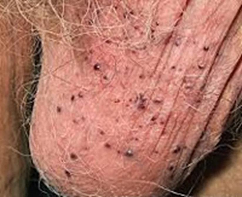 Заболевание кожи, вызванное патогенными грибами